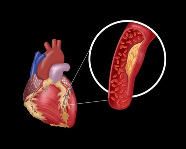 重症冠心病不支架不搭桥怎么办,冠心病三支病变做支架还是搭桥