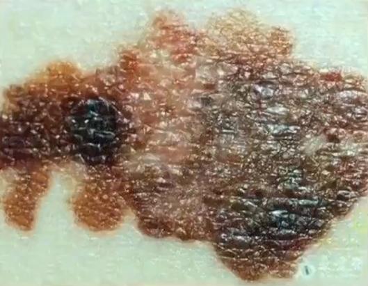 你身上的痣是什么,你身上的痣代表什么