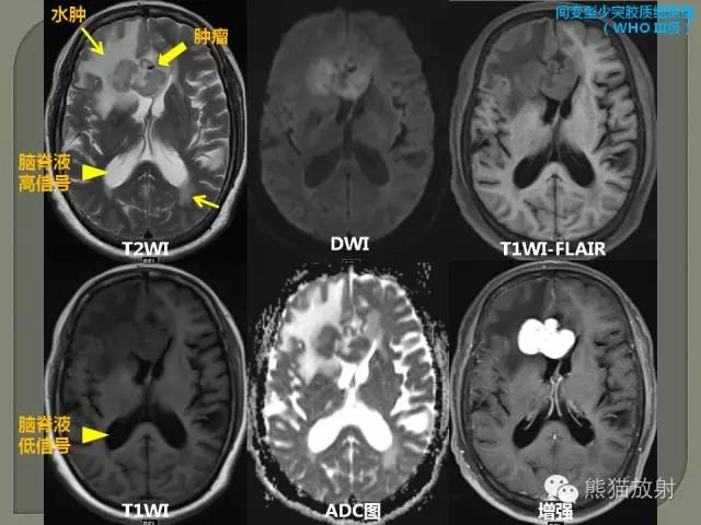 如何简单理解、认识MRI图像
