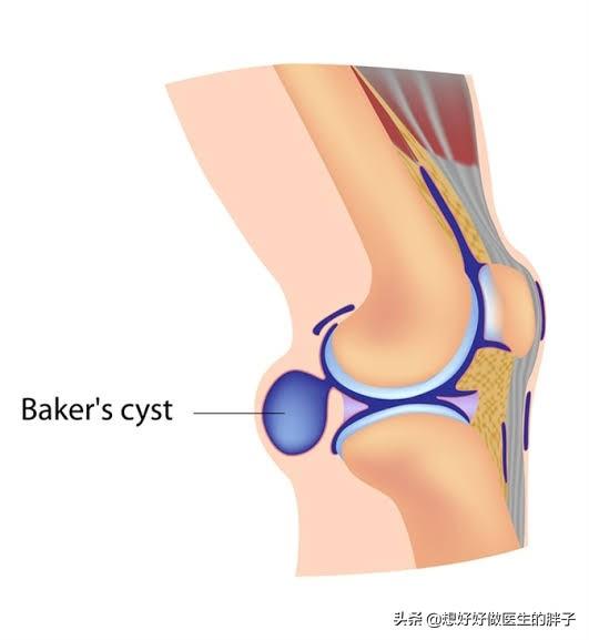 辟谣囊肿手术,如果囊肿是良性的话要不要做手术