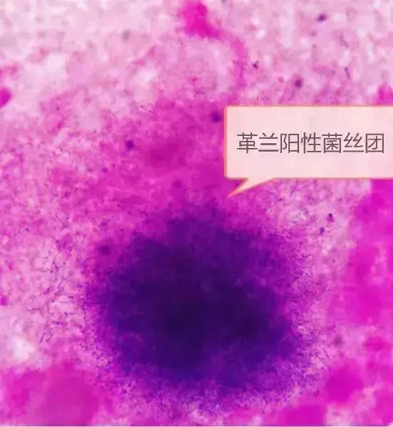 【提醒】他摸了出土*物文**，然后住院八次