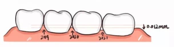牙龈上有白色的牙垢刷不掉,牙龈里的黑东西