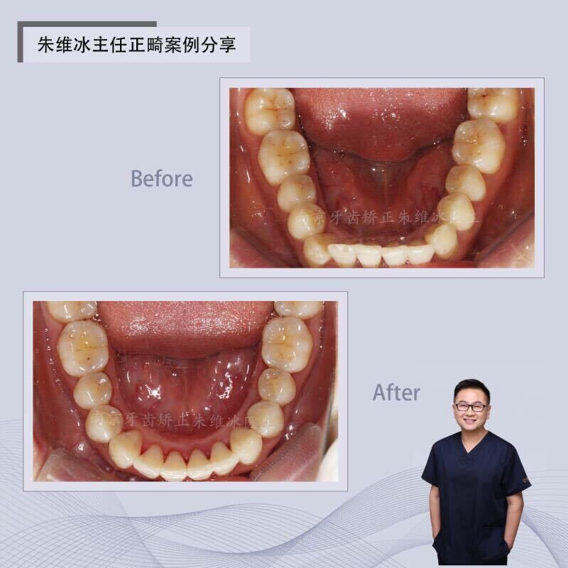南京正畸朱维冰怎么样,南京牙齿正畸矫正技术