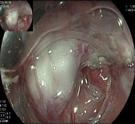 贲门隆起性病变影像,贲门溃疡隆起性病变