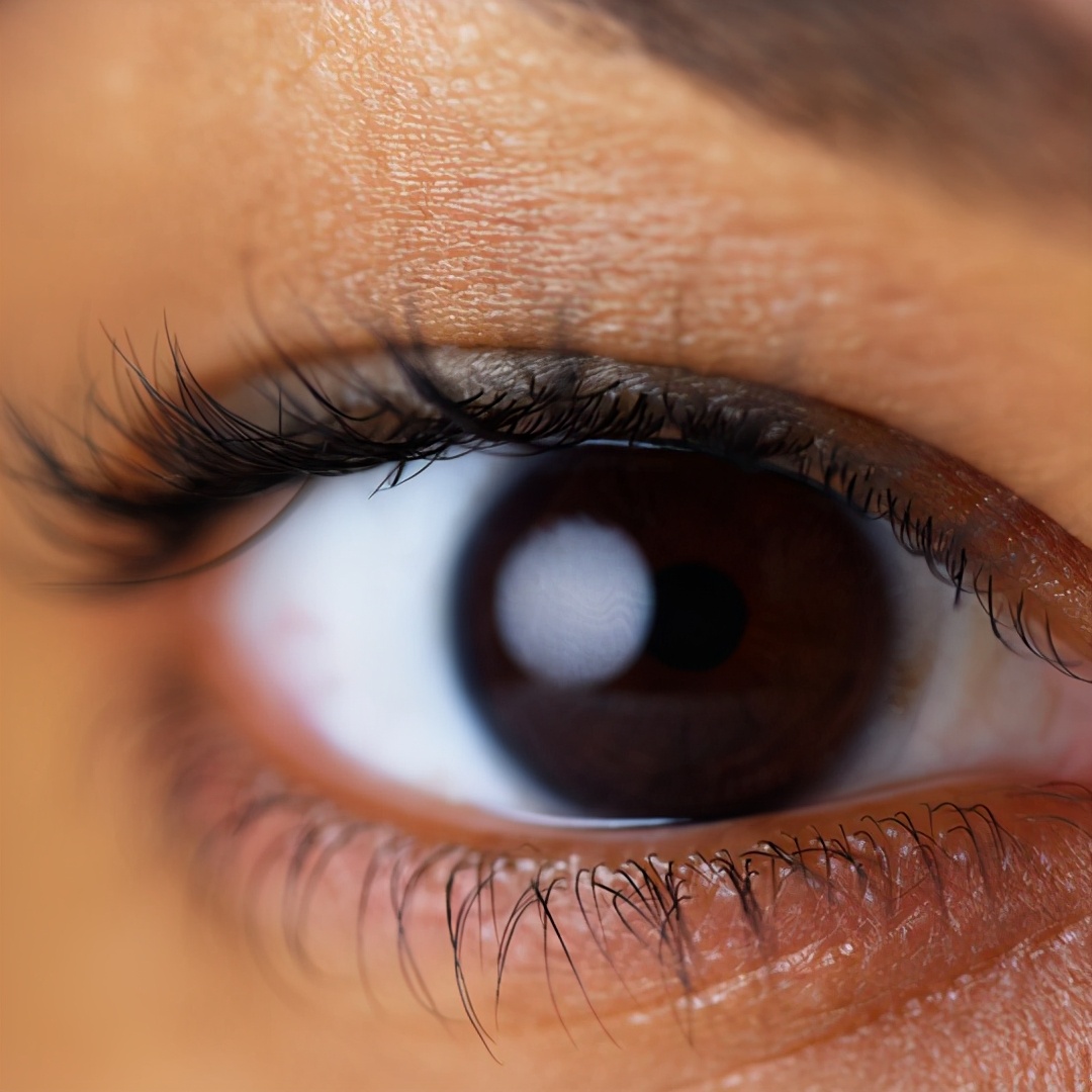 双眼皮刚刚做完和一个月后的对比,双眼皮做完太自然和没做一样