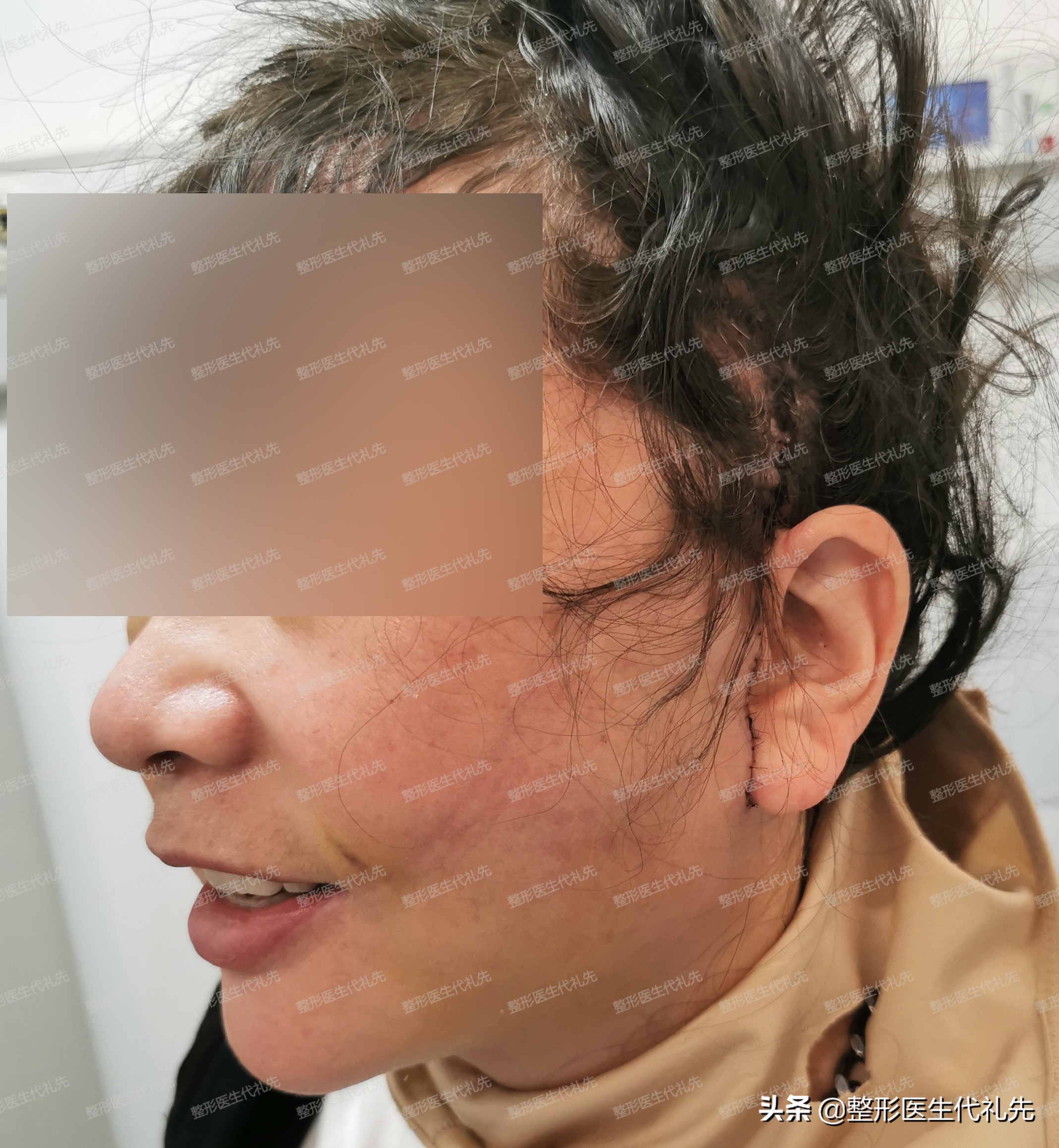 大拉皮和面部微创提升术的区别,小切口面部提升是小拉皮手术吗