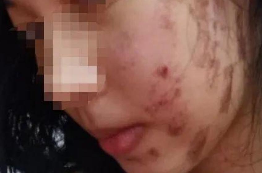 女子做完光子嫩肤后脸上全是黑疤,做完光子嫩肤后怎么黑了