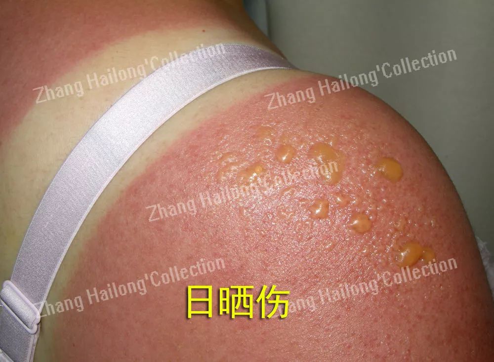 晒太阳两分钟会被紫外线伤到吗,太阳太晒如何防护