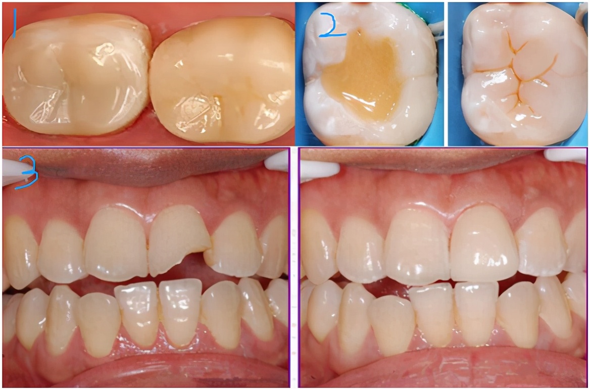 600块钱一颗牙怎么样,600块一颗牙贵吗
