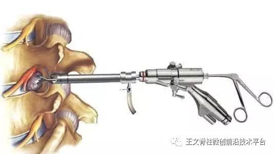 腰椎管狭窄相关知识,一文看懂骶管囊肿