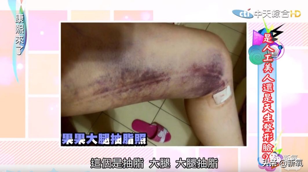 花90万从头整到脚，还可以这么自然？旁边纯天然小姐姐都看懵了