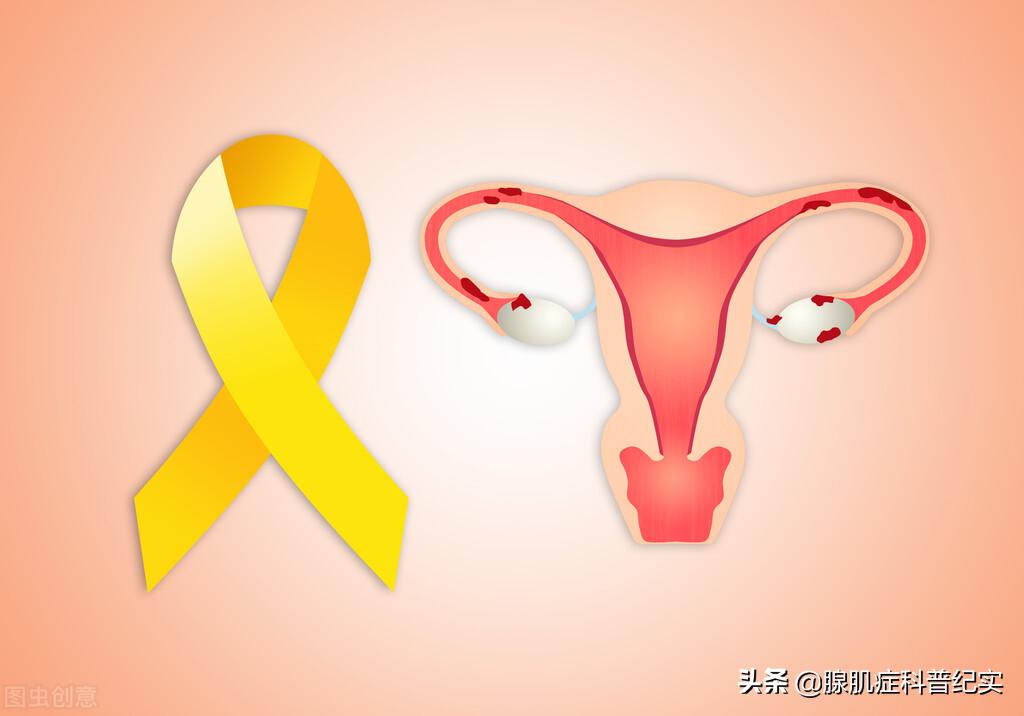 为什么会有腺肌症,腺肌症月经完了肚子还痛怎么回事