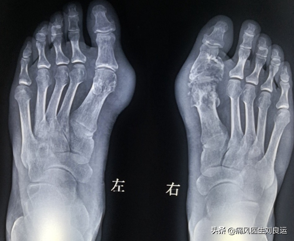 痛风会在脚趾和膝关节同时发作吗,痛风发作从脚趾头到脚踝又到膝盖