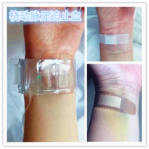 从手腕处做子宫动脉栓塞手术,子宫肌瘤做动脉穿刺有危险吗