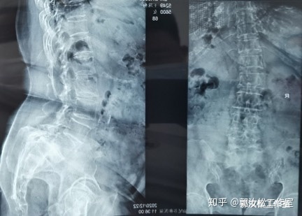 老年人腰痛慢性损伤怎么治疗 (老年人腰痛要怎么才能治好)