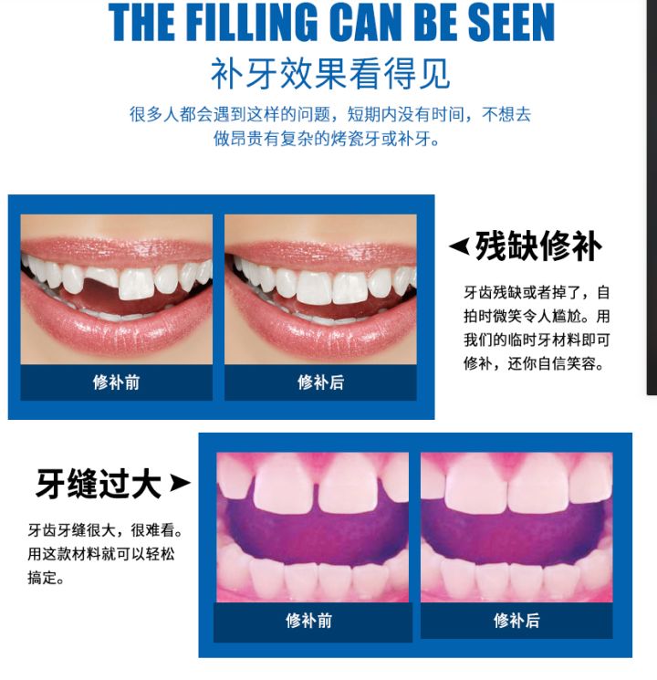 做一颗临时牙教程,自制隐形牙