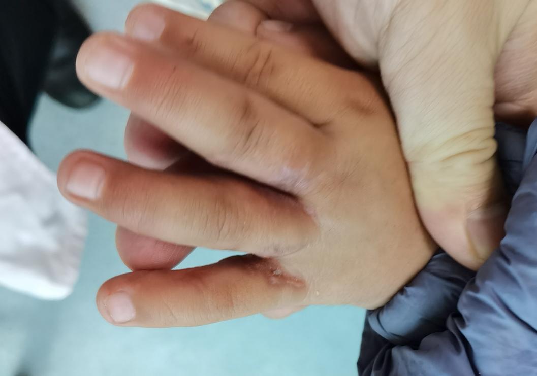 并指畸形免植皮案例,并指畸形