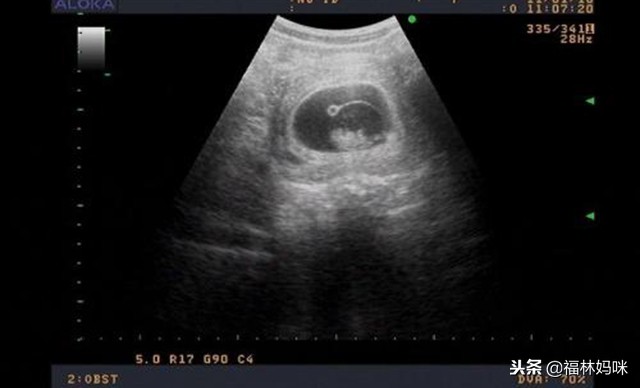 孕检发现孕酮低,胎儿还能保住吗?医生往往会给这样的建议