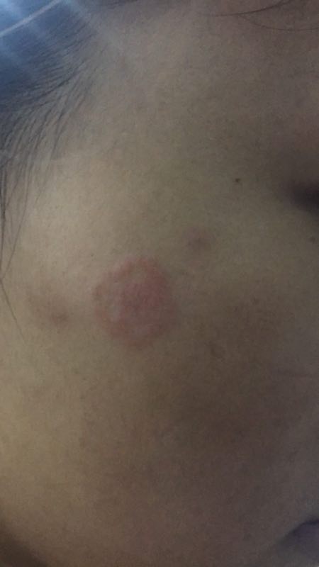 贪便宜花800元买了只蓝猫，一身猫癣还传染给了自己（真实案例）