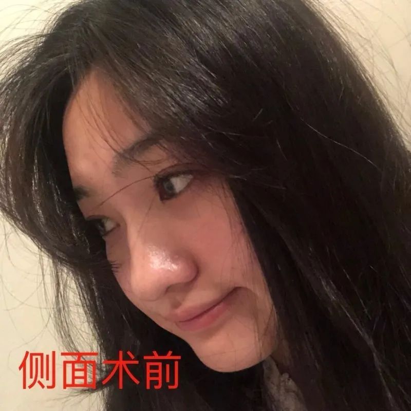 耳软骨垫鼻尖膨体垫鼻梁,膨体做鼻梁和鼻尖