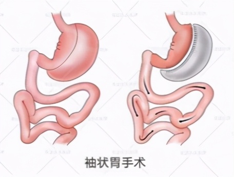 肥胖的原因和危害及减肥措施,什么是造成肥胖的主要原因