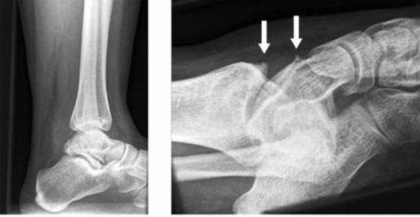 骨刺怎么治才能彻底根除骨质增生,脚脖子骨质增生有骨刺能贴膏药吗