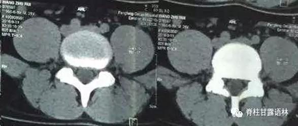 腰椎间盘突出中央型和旁侧型,腰椎间盘与椎板间隙的对应关系