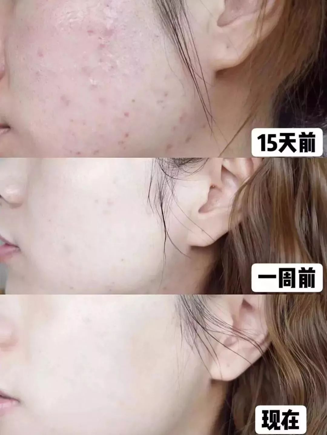 脸上螨虫多出油厉害怎么办,脸上螨虫过敏烂脸