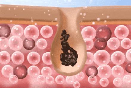 油性肌肤应该怎么样去除黑头,油腻皮肤毛孔粗大黑头多怎么清理