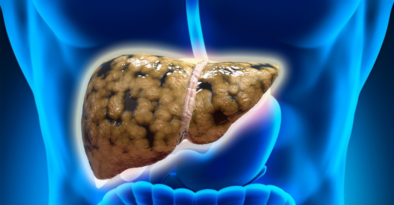 预防脂肪肝打的什么针,喝沙棘能预防脂肪肝吗