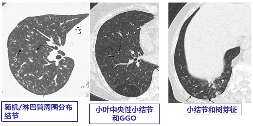 专家讲新冠二次感染的情况讲解,感染新冠专家怎么说