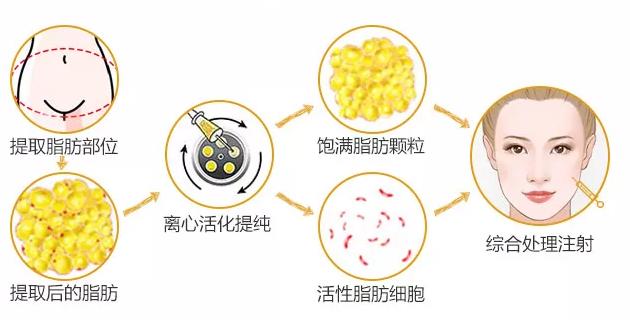 40多岁的人最适合做的除皱项目,目前国内最好的除皱方法是什么