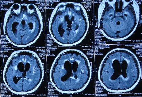 结核性脑积水,脑膜炎脑积水要治疗多久