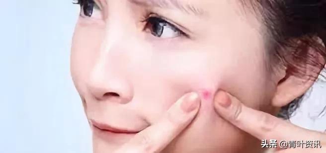 孕期长痘痘该怎么办,孕期长痘痘又不能乱用药该怎么治