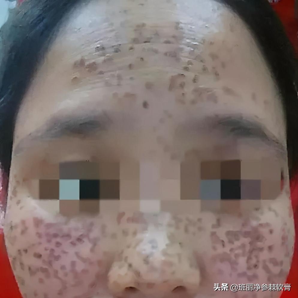 现在很多人都在祛斑靠谱吗,到底祛斑是真的还是假的