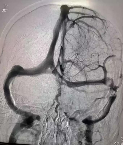 长治市人民医院成功完成一例颅内静脉支架植入术