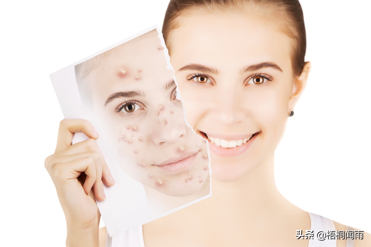 别乱用祛痘产品对症下药才能治痘,祛痘乱用偏方