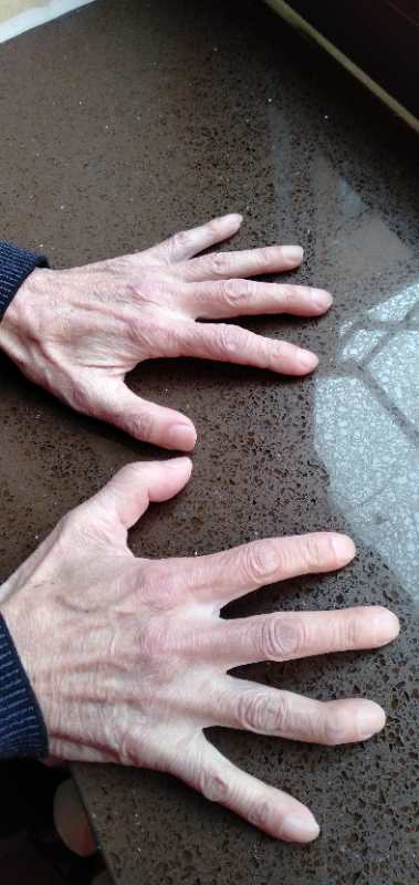 中西医结合治疗原因不明肠梗阻、腹水转氨酶明显升高病案一例！