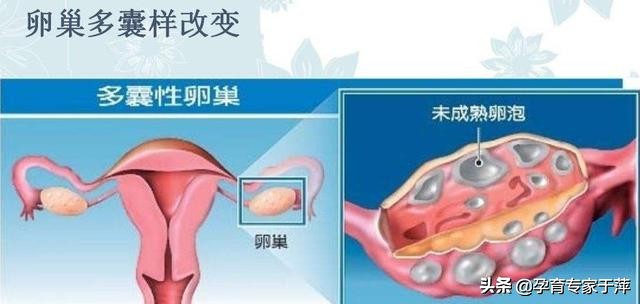 瘦多囊为什么要减肥,胖多囊怎么减肥效果好