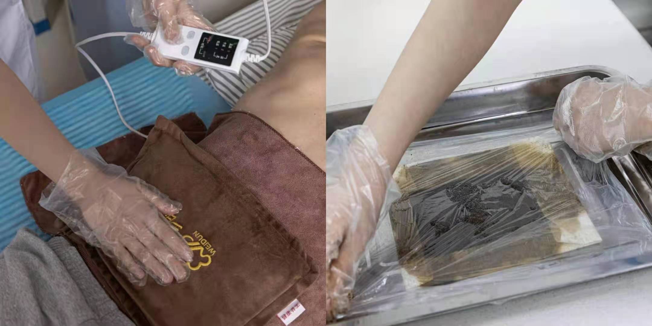 股骨头坏死吃中药扎针灸能好吗,中药治疗股骨头坏死哪里医院好