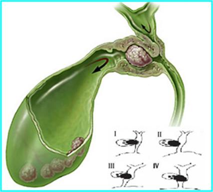 胆结石会引起黄疸腹疼吗,胆结石胆囊炎伴有黄疸应该怎么办