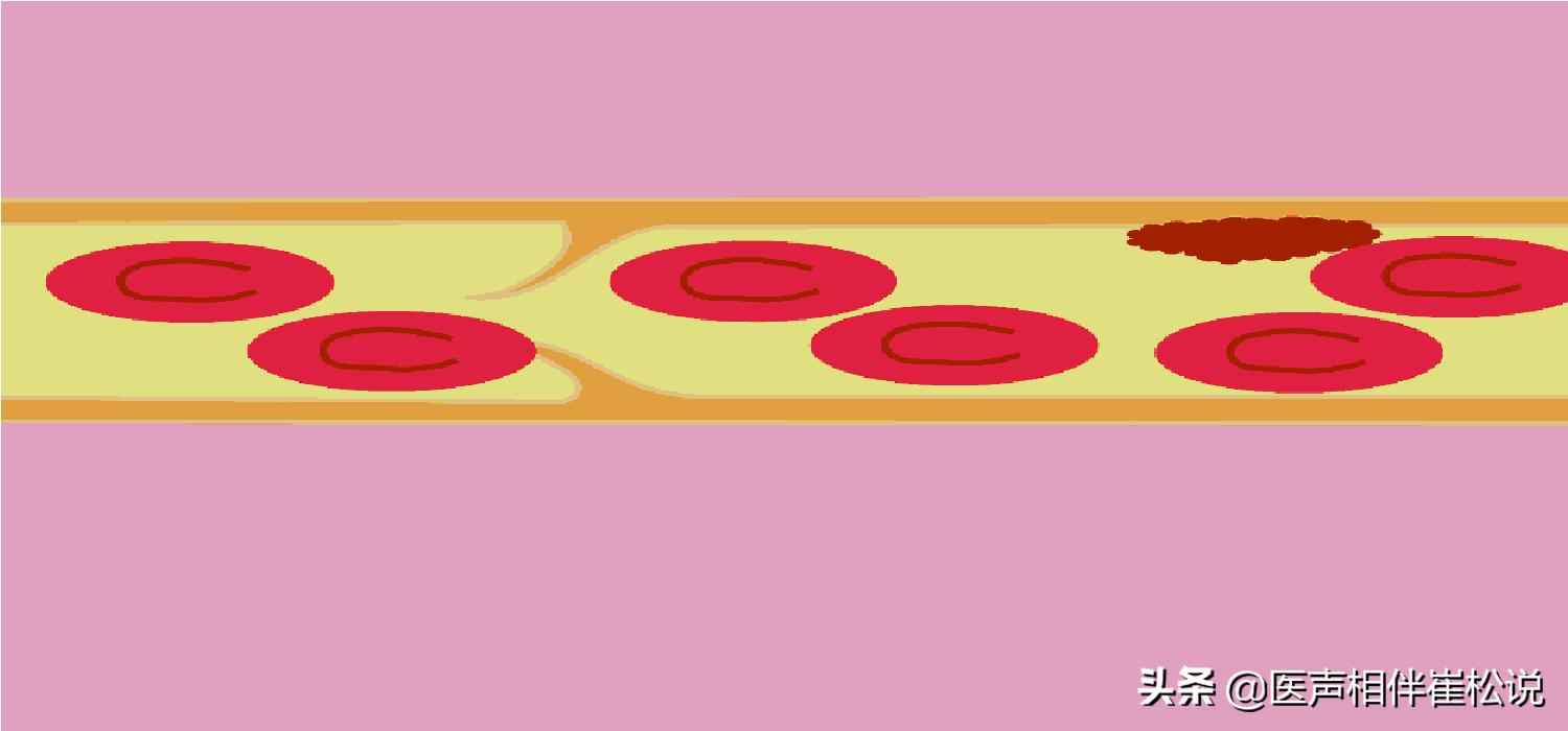 脑梗和腔梗是一回事儿吗,脑梗和腔梗是一回事吗