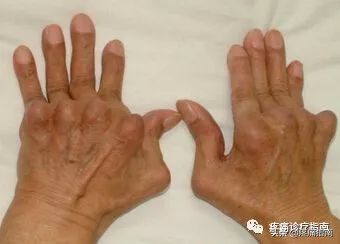 骨性关节炎诊疗方案及流程,骨性关节炎的护理诊断