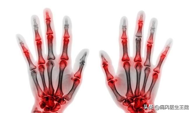 痛风石对骨质的危害,痛风石怎么可以溶解掉