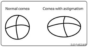 怎么按摩眼睛改善散光,怎么锻炼眼睛能改善散光