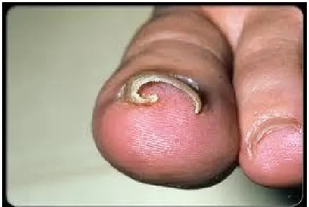 指甲老往肉里长化脓,指甲为什么一直往肉里长