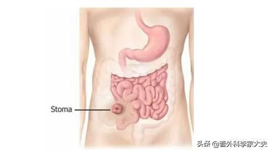 直肠癌手术后肠瘘有什么危险,直肠癌手术后肠漏怎么处理