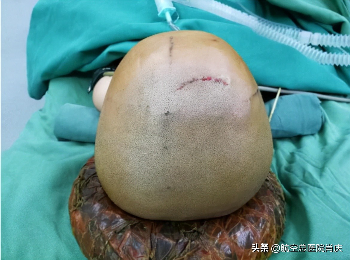 鞍上池蛛网膜囊肿手术费用,鞍上池蛛网膜囊肿影响智力吗