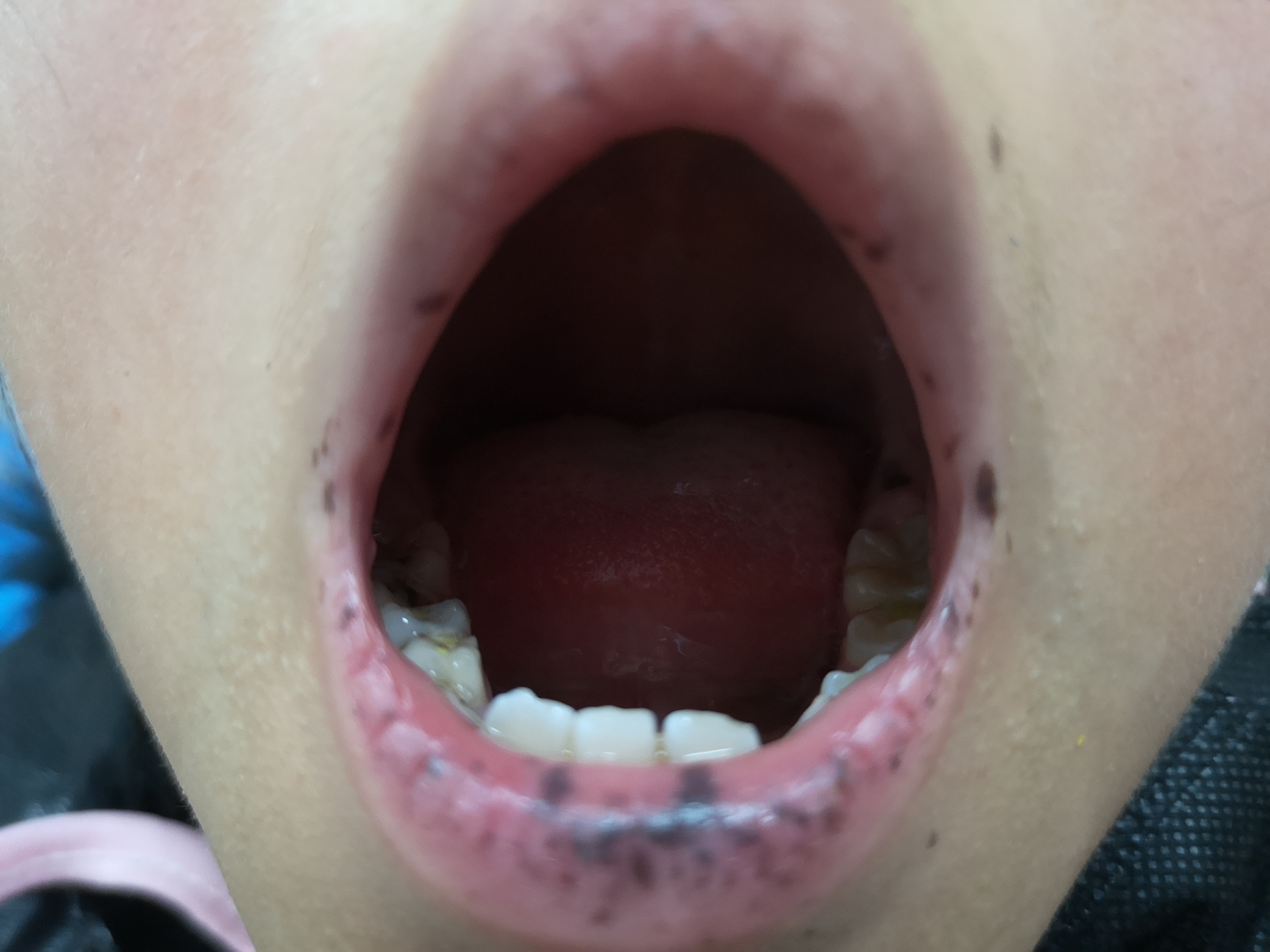 警惕这种黑痣可能是恶性肿瘤,这些地方有黑痣要注意了