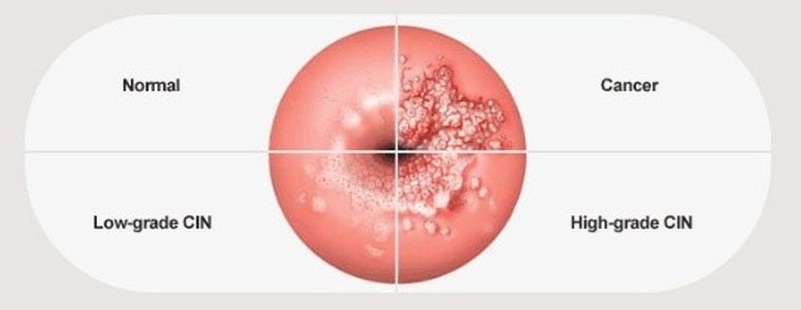 宫颈癌是女性杀手,宫颈癌成为女性杀手